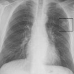 northside lung nodule clinic x ray