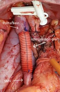 Figure 1 SMV graft