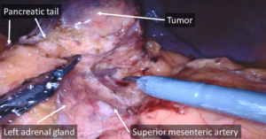 Figure 2 XI panc