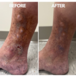 before and after vein treatment graphic image