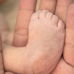 Clubfoot & The Ponseti Method: Compassionate Care Tailored for Your Child