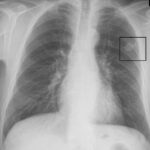 Northside Atlanta Opens New Lung Nodule Clinic