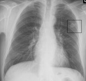 Northside Atlanta Opens New Lung Nodule Clinic