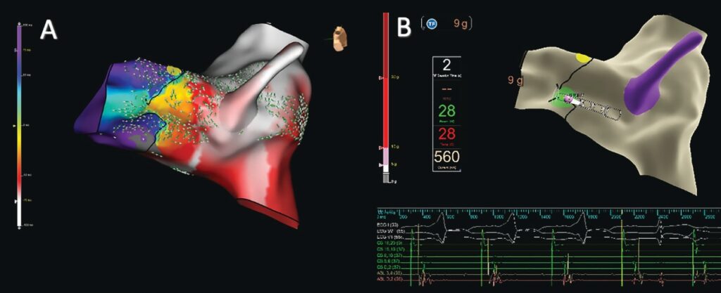 From Palpitations to the EP Lab