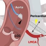 Coronary Artery Bypass