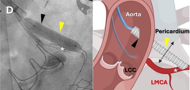 Coronary Artery Bypas