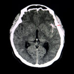 PIANO Trial for Brain Aneurysms