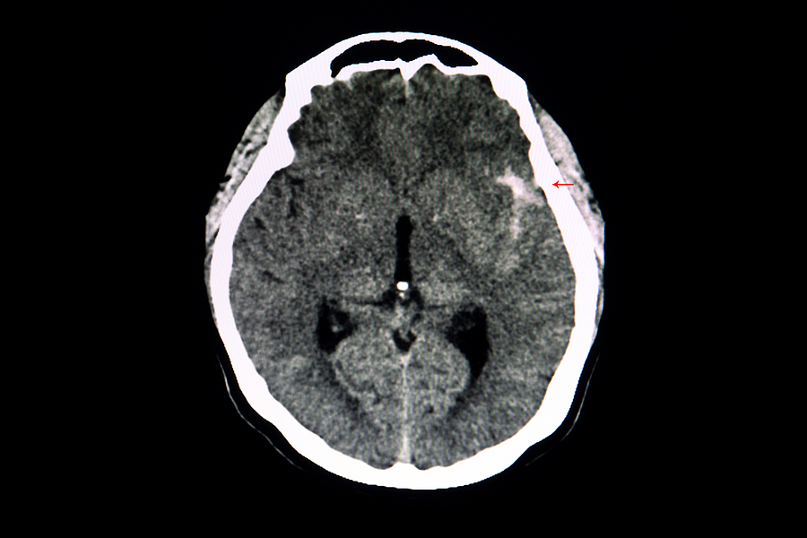 PIANO Trial for Brain Aneurysms