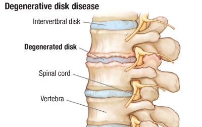 Lumbar Degenerative Disk Disease