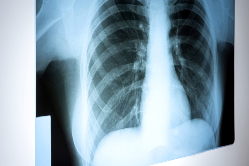 Piedmont Launches Expanded Lung Transplant Program