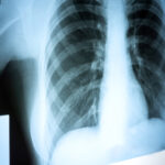 Expanded Lung Transplant Program